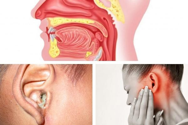 Viêm mũi họng, nấm ống tai, nhiễm trùng tai là những nguyên nhân gây ngứa tai